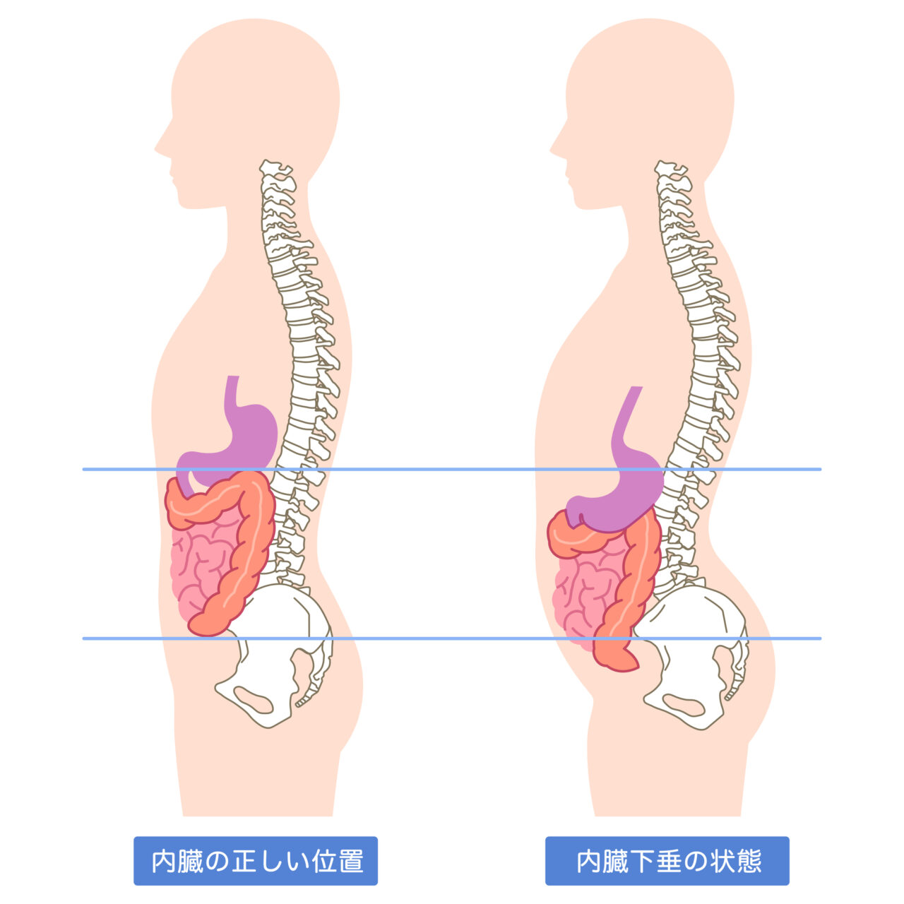 反り腰による内臓下垂の状態