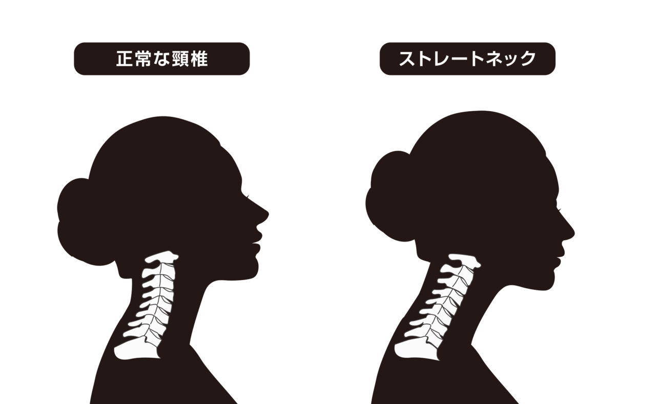 正常な頸椎とストレートネックの比較
